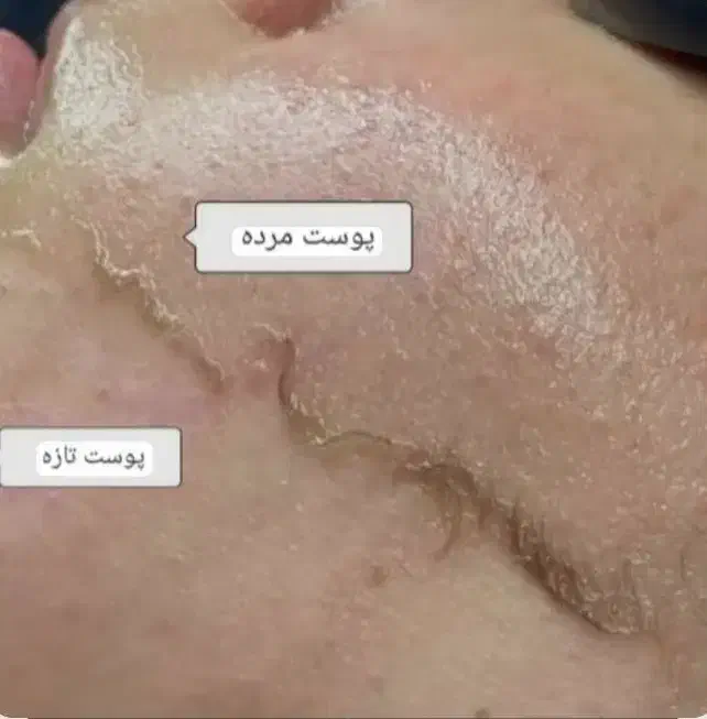فیشیال (پاکسازی پوست) تخفیف ویژه|خدمات آرایشگری و زیبایی|رشت, رشتیان|دیوار