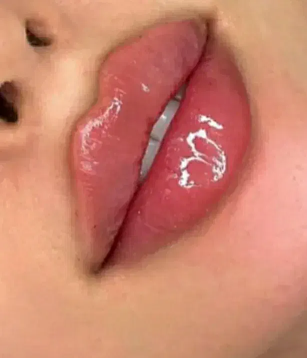 تخفیف 50 درصدی تزریق ژل و بوتاکس|خدمات آرایشگری و زیبایی|ارومیه, |دیوار