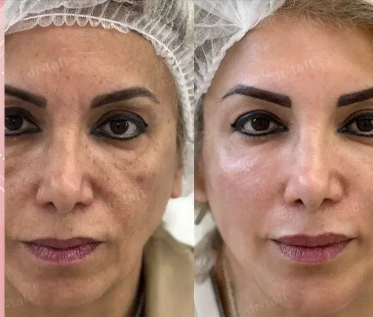 فیلرزیر چشم، زاویهفک، لیفت شقیقه، بوتاکس، لب نچرال|خدمات آرایشگری و زیبایی|مشهد, سرافرازان|دیوار