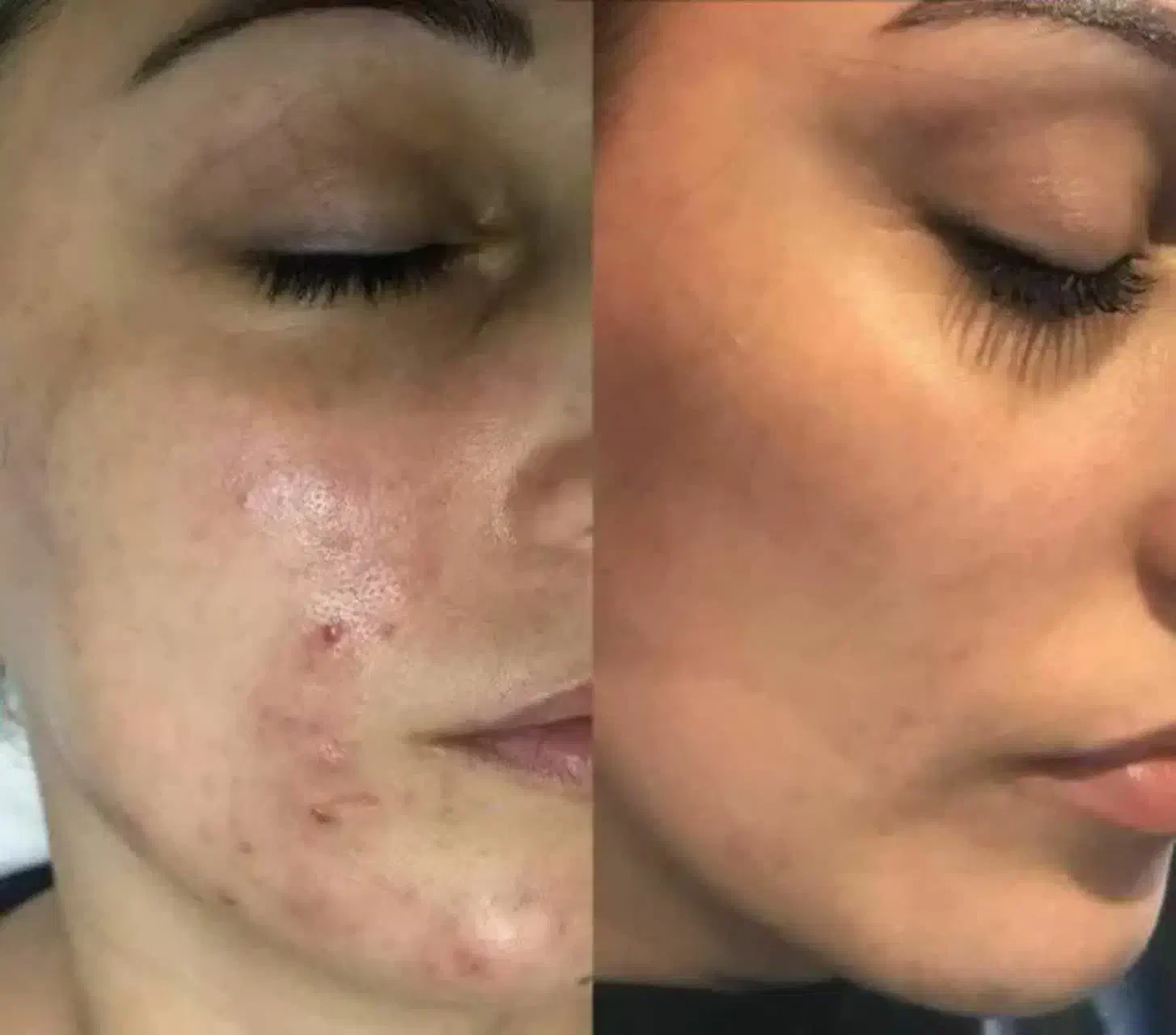 کرم معجزه از بین برنده لکه و جوش و جای جوش|آرایشی، بهداشتی، درمانی|اردبیل, |دیوار