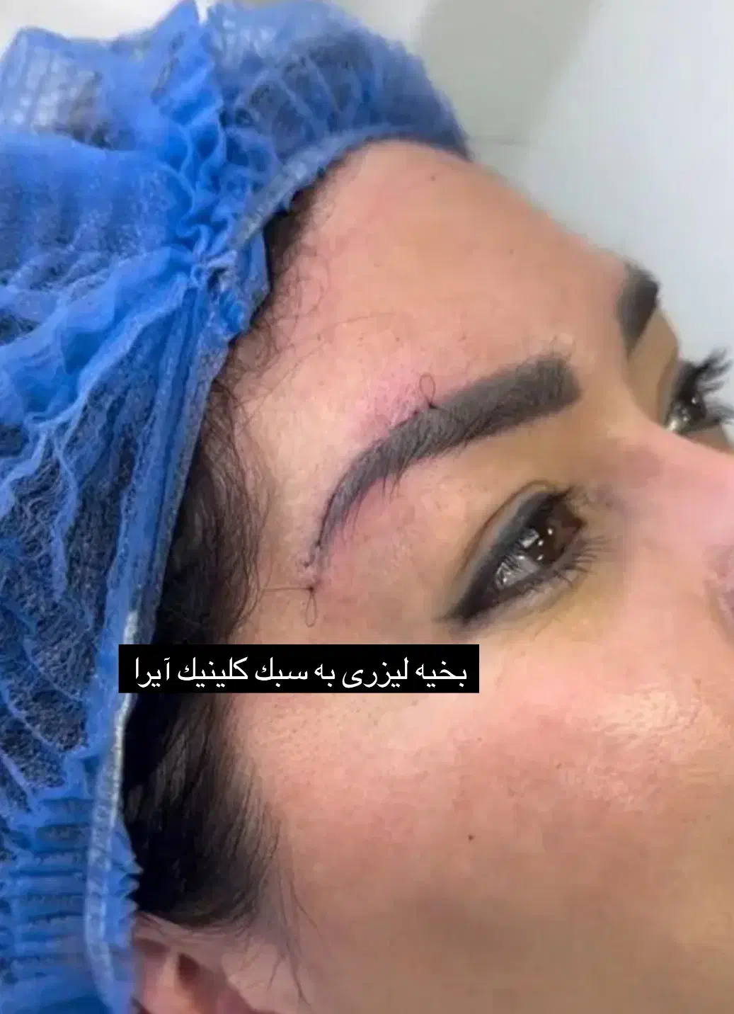 جراحی لیفت ابرو،دایرکت ابرو،لیفت شقیق ،پیشانی|خدمات آرایشگری و زیبایی|تهران, پاسداران|دیوار