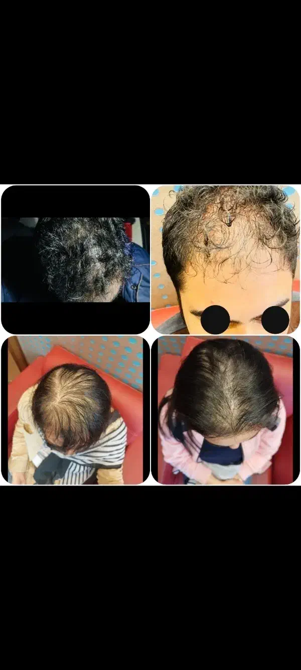 لیزر موهای زاید فیلر ژل بوتاکس مزو خال هایفو prp|خدمات آرایشگری و زیبایی|تبریز, |دیوار