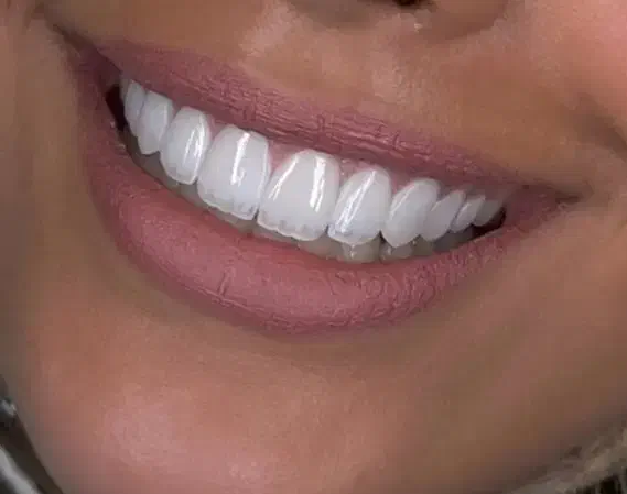 شرایط ویژه جشنواره دندانپزشکی ایمپلنت و اوردنچر|خدمات آرایشگری و زیبایی|آذرشهر, |دیوار