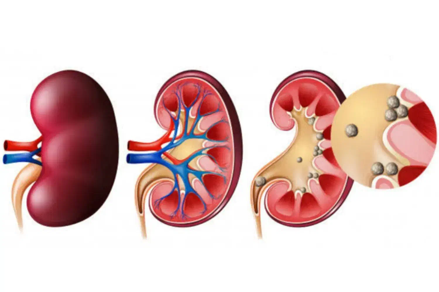 درمان سنگ کلیه|آرایشی، بهداشتی، درمانی|خاش, |دیوار