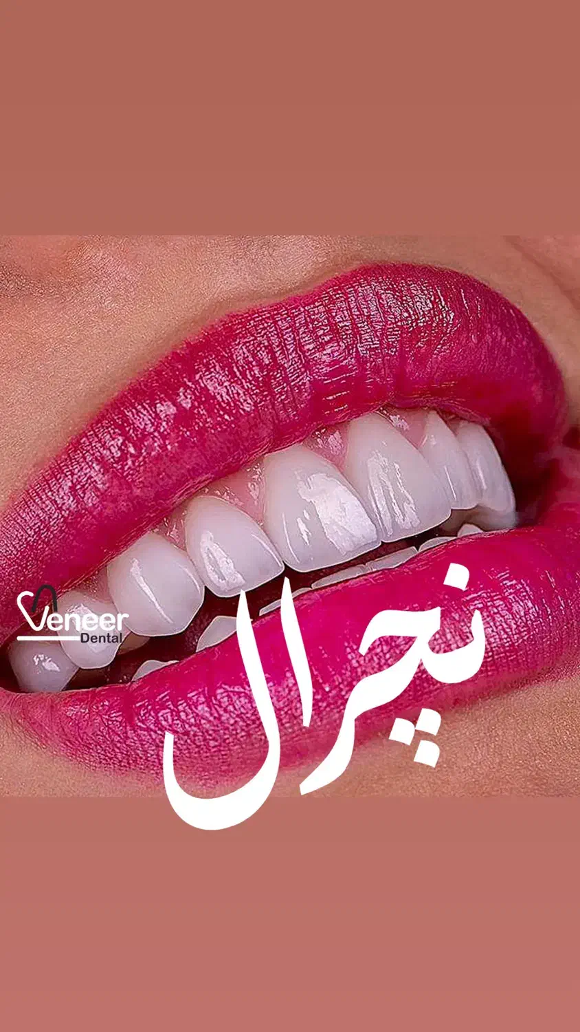 دندانیزشکی کامپوریت لمینت اینیلنت|خدمات آرایشگری و زیبایی|تهران, قیطریه|دیوار