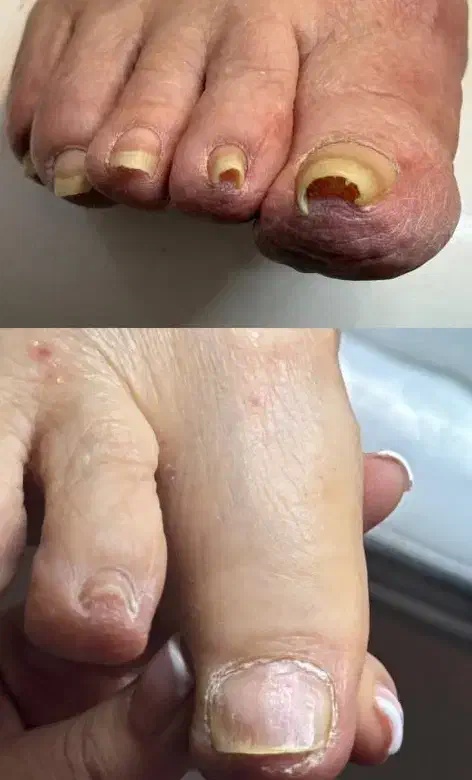 خارج کردن ناخن از داخل گوشت  و نصب ارتونیل|خدمات آرایشگری و زیبایی|مشهد, شهرک امام هادی (شهرک غرب)|دیوار