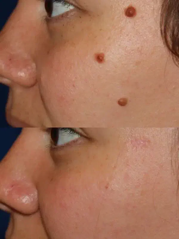 خال برداری رفع کک و مک با لیزر|خدمات آرایشگری و زیبایی|هشتگرد, مدرس|دیوار