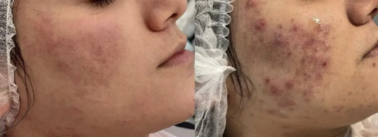 مدل برای درمان لک و اکنه(جوش) و اسکار وتیرگی بدن|خدمات آرایشگری و زیبایی|کاشان, فاز ۱ ناجی آباد|دیوار