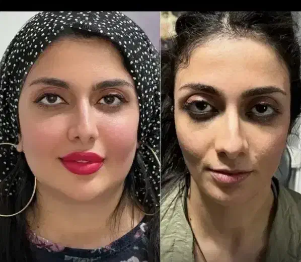 ژل فیلر بوتاکس گونه لب چانه و غیره ۱۸۰۰|خدمات آرایشگری و زیبایی|زاهدان, |دیوار