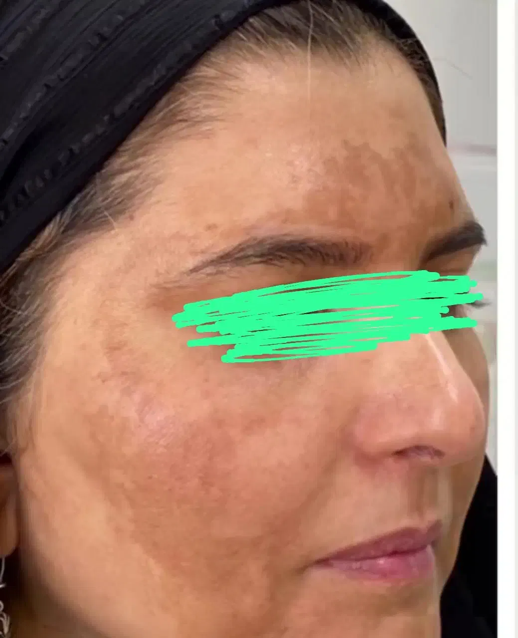 کرم ضد لک تخصصی|آرایشی، بهداشتی، درمانی|ایرانشهر, |دیوار