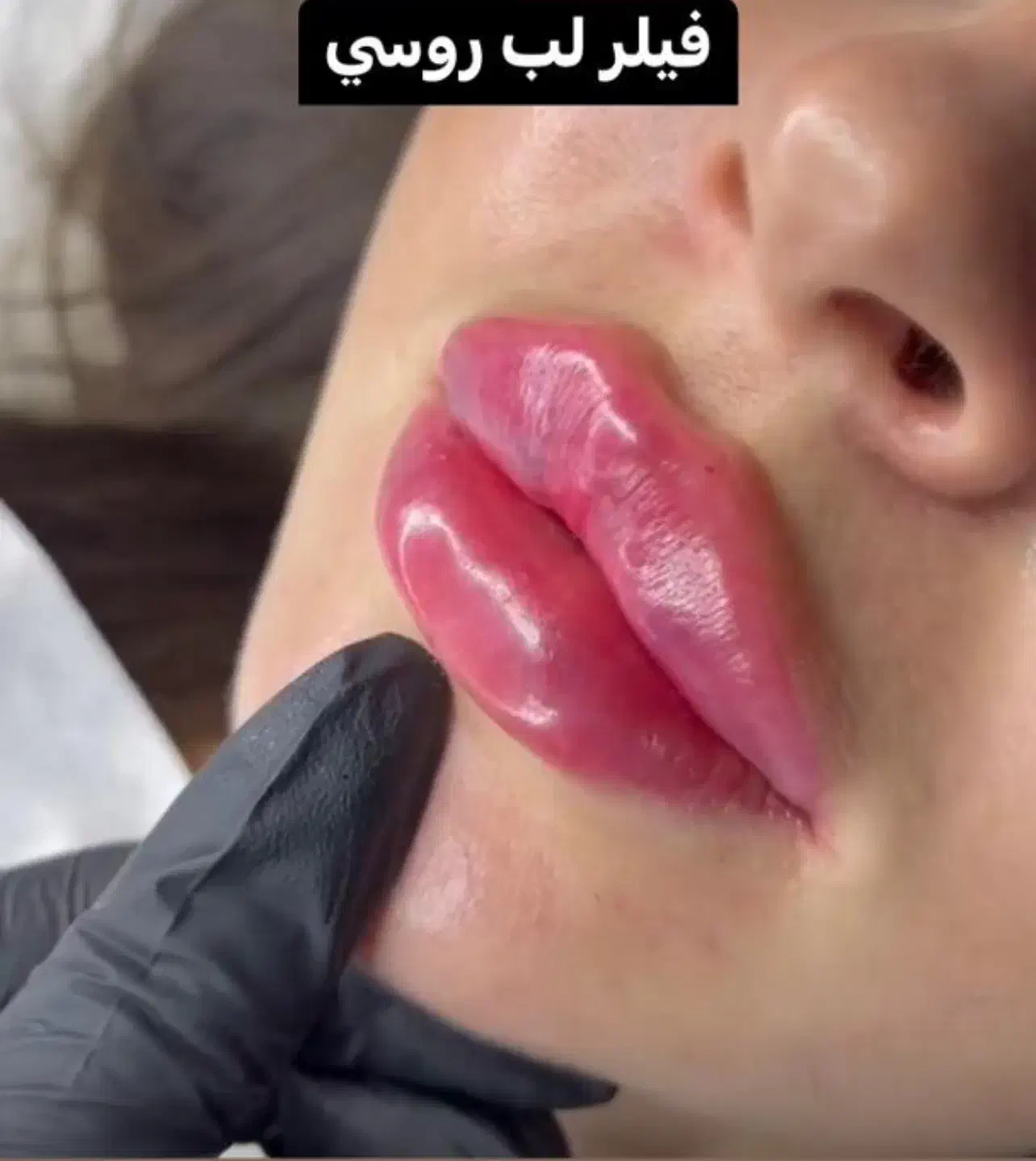 جشنواره ژل و بوتاکس و مزوژل|خدمات آرایشگری و زیبایی|تهران, ظفر|دیوار