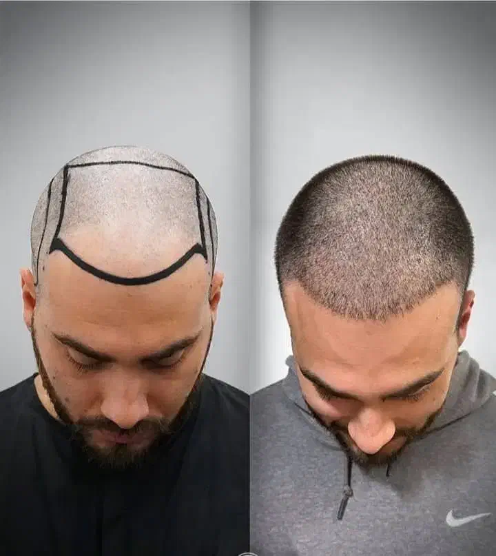 جشنواره پاییزه کاشت مو و کاشت ابرو|خدمات آرایشگری و زیبایی|تهران, دردشت|دیوار