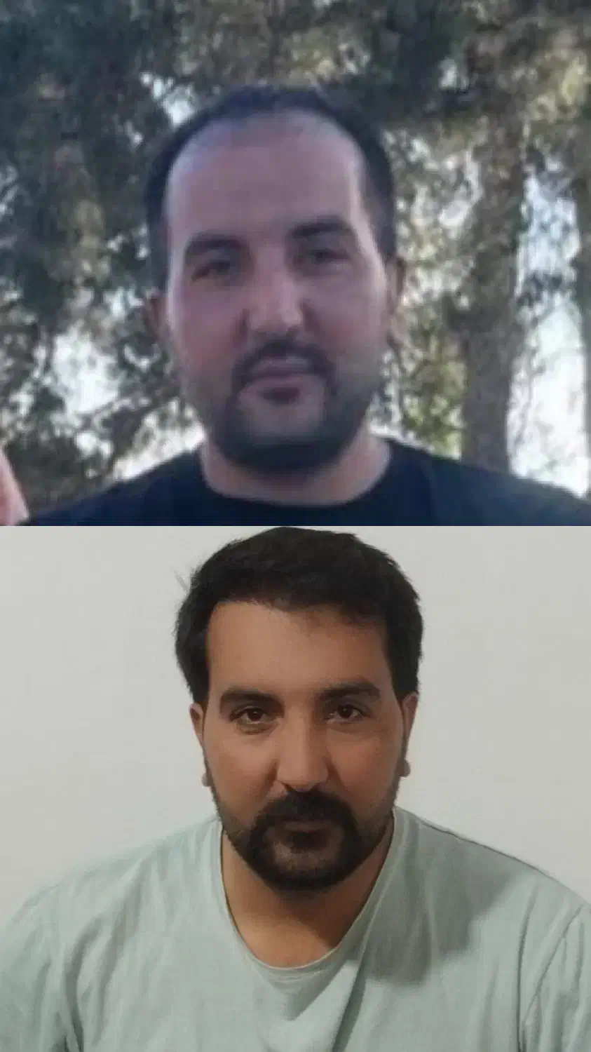 کاشت مو فول تراکم تضمینی|خدمات آرایشگری و زیبایی|گرگان, |دیوار