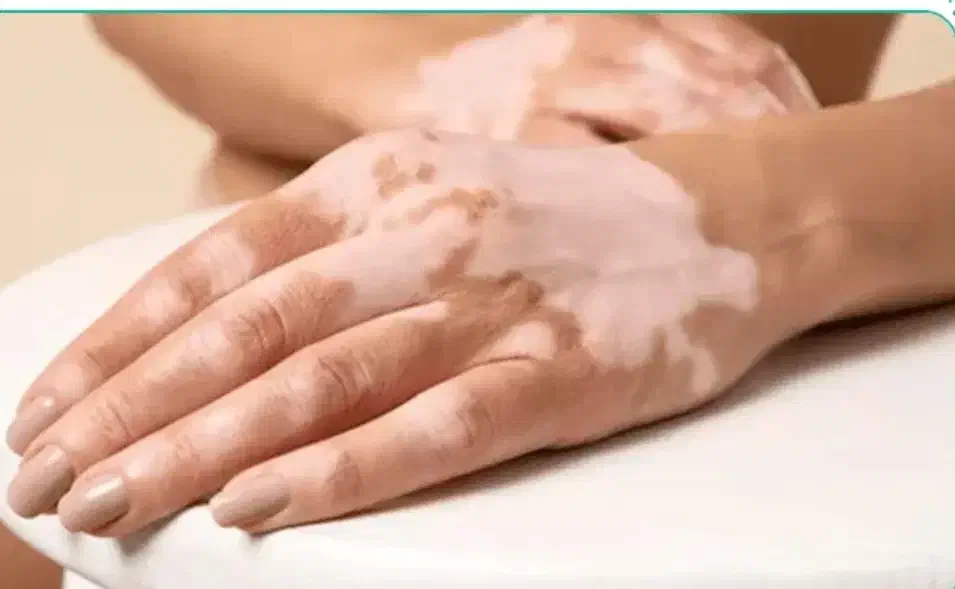 درمان انواع بیماریهای پوستی|آرایشی، بهداشتی، درمانی|شاهرود (اردبیل), |دیوار