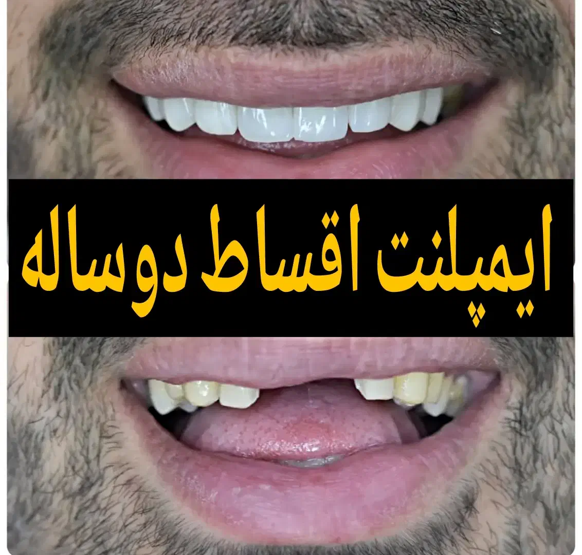 ایمپلنت دیجیتال دندان از دم اقساط اوردنچر کاشت|خدمات آرایشگری و زیبایی|تهران, قیطریه|دیوار
