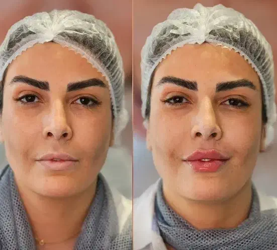 تزریقات زیبایی با 60٪ تخفیف|خدمات آرایشگری و زیبایی|برازجان, |دیوار