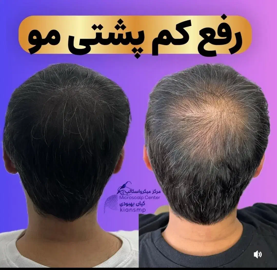 شبیه سازی فولیکول مو smp اس کالپ|خدمات آرایشگری و زیبایی|دوگنبدان, |دیوار