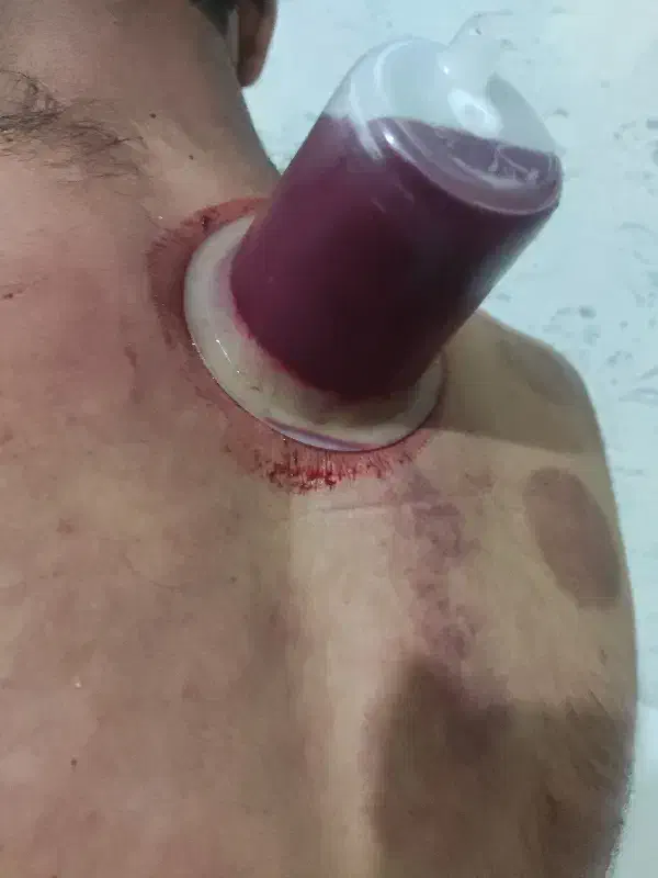 حجامت و تزریقات در منزل توسط پرستار با سابقه|خدمات آرایشگری و زیبایی|زابل, |دیوار