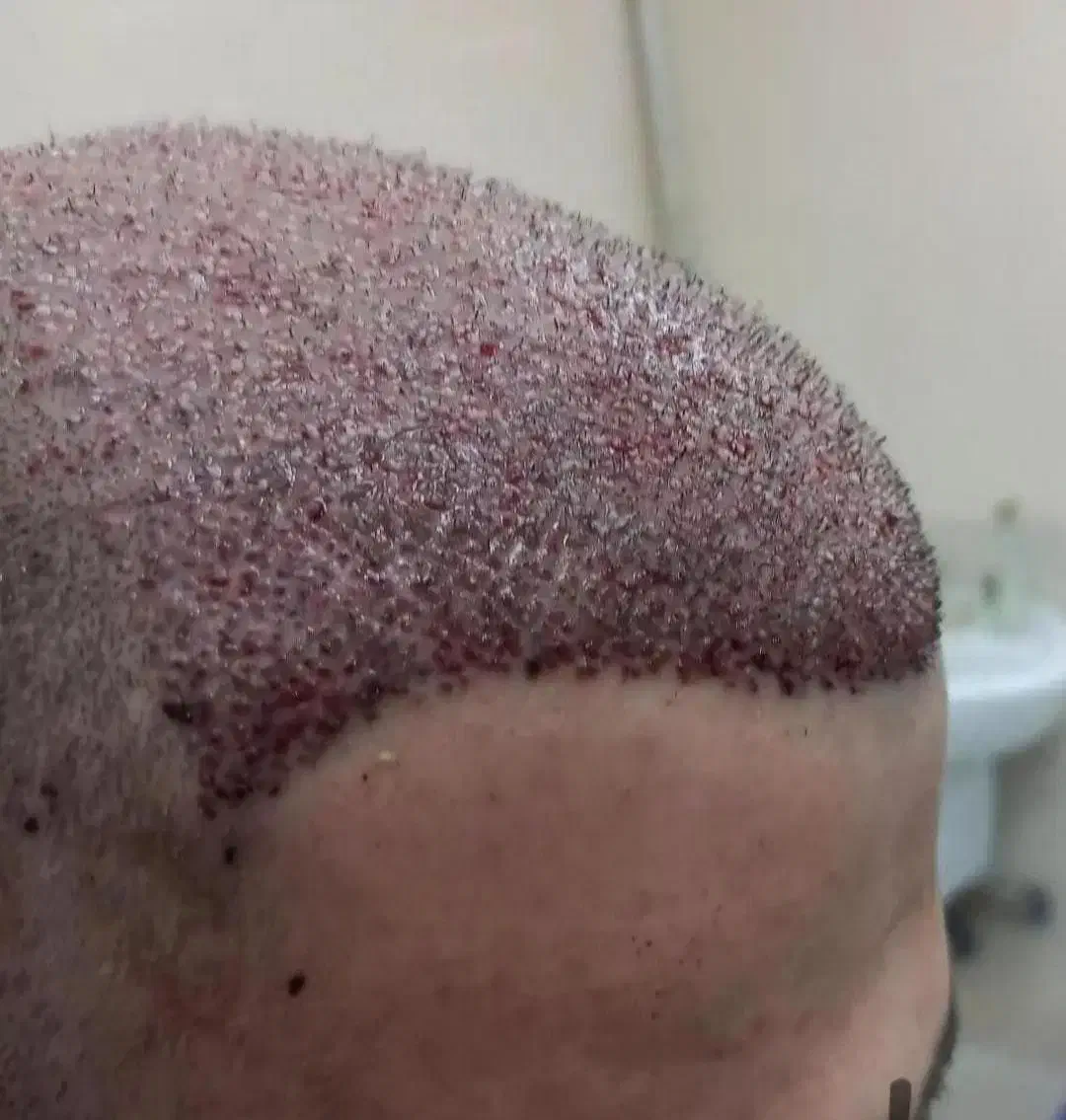 کاشت مو طبیعی له روش میکروfit وsut|خدمات آرایشگری و زیبایی|رامشیر, |دیوار