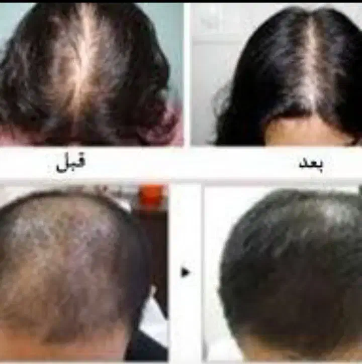 محلول و درمان رشد موی سر کاملا گیاهی|آرایشی، بهداشتی، درمانی|مهاباد (آذربایجان غربی), |دیوار