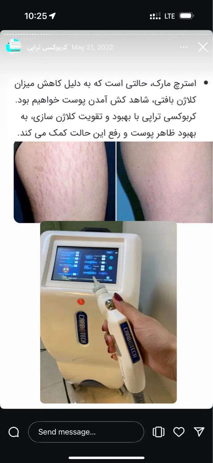 لیزر بوتاکس پی ارپی توسط دکتر|خدمات آرایشگری و زیبایی|مشهد, وکیلآباد|دیوار