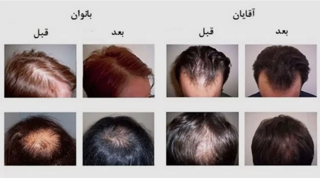 PRGF|خدمات آرایشگری و زیبایی|مشهد, فردوسی|دیوار
