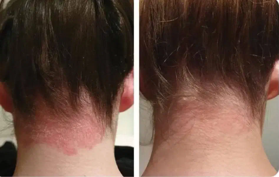 درمان مشکلات پوستی|آرایشی، بهداشتی، درمانی|جوانرود, |دیوار