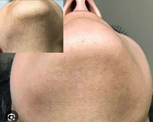 الکترولیز موهای زائد|خدمات زیبایی و سلامت|شیراز, شهرک بزین|دیوار