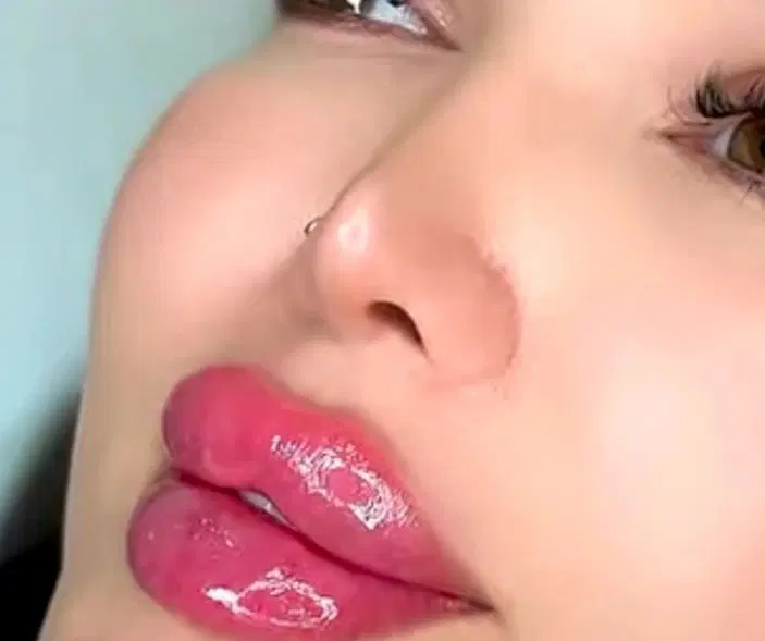 ژل لب و مادلینگ 450 هزارتومان توسط پزشک کلینیک|خدمات زیبایی و سلامت|کرج, گوهردشت|دیوار