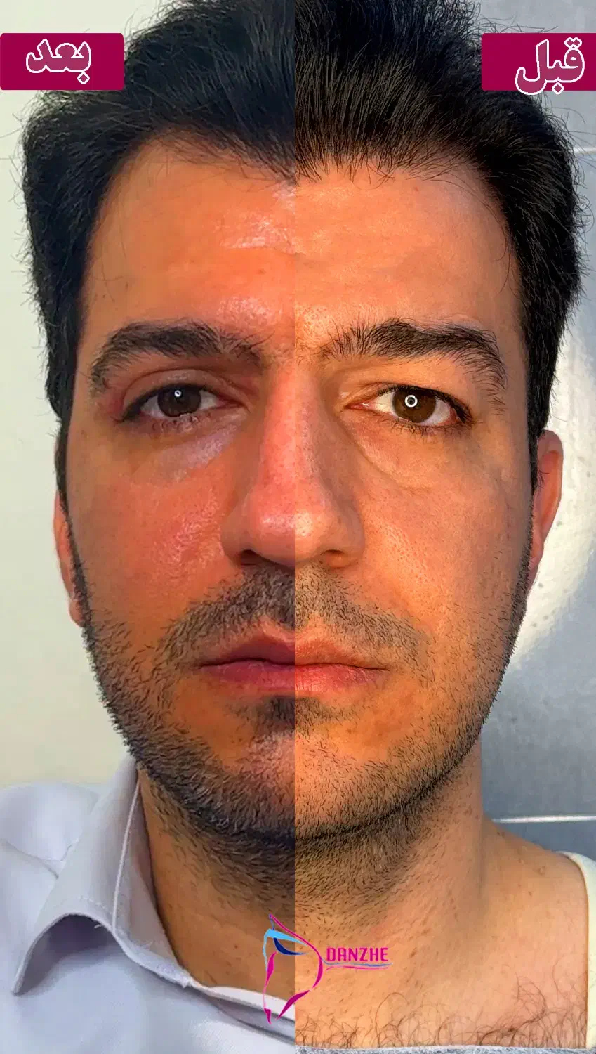 بلفاروپلاستی توسط متخصص چشم با بخیه سوپرنانو لیزری|خدمات آرایشگری و زیبایی|تهران, جردن|دیوار