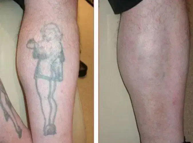 پاک کردن تتو.لیزرکیوسوییچ.PRP.کربن تراپی.روشن سازی|خدمات آرایشگری و زیبایی|اصفهان, سعادتآباد|دیوار