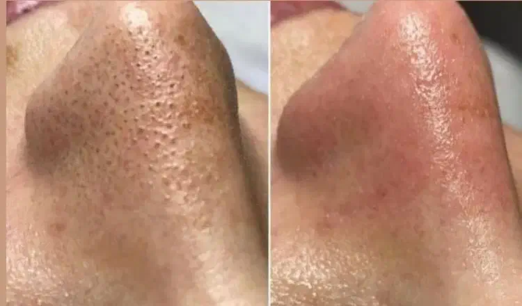 پاکسازی پوست فیشال پوست فیشیال پوست|خدمات آرایشگری و زیبایی|تهران, مجیدیه|دیوار