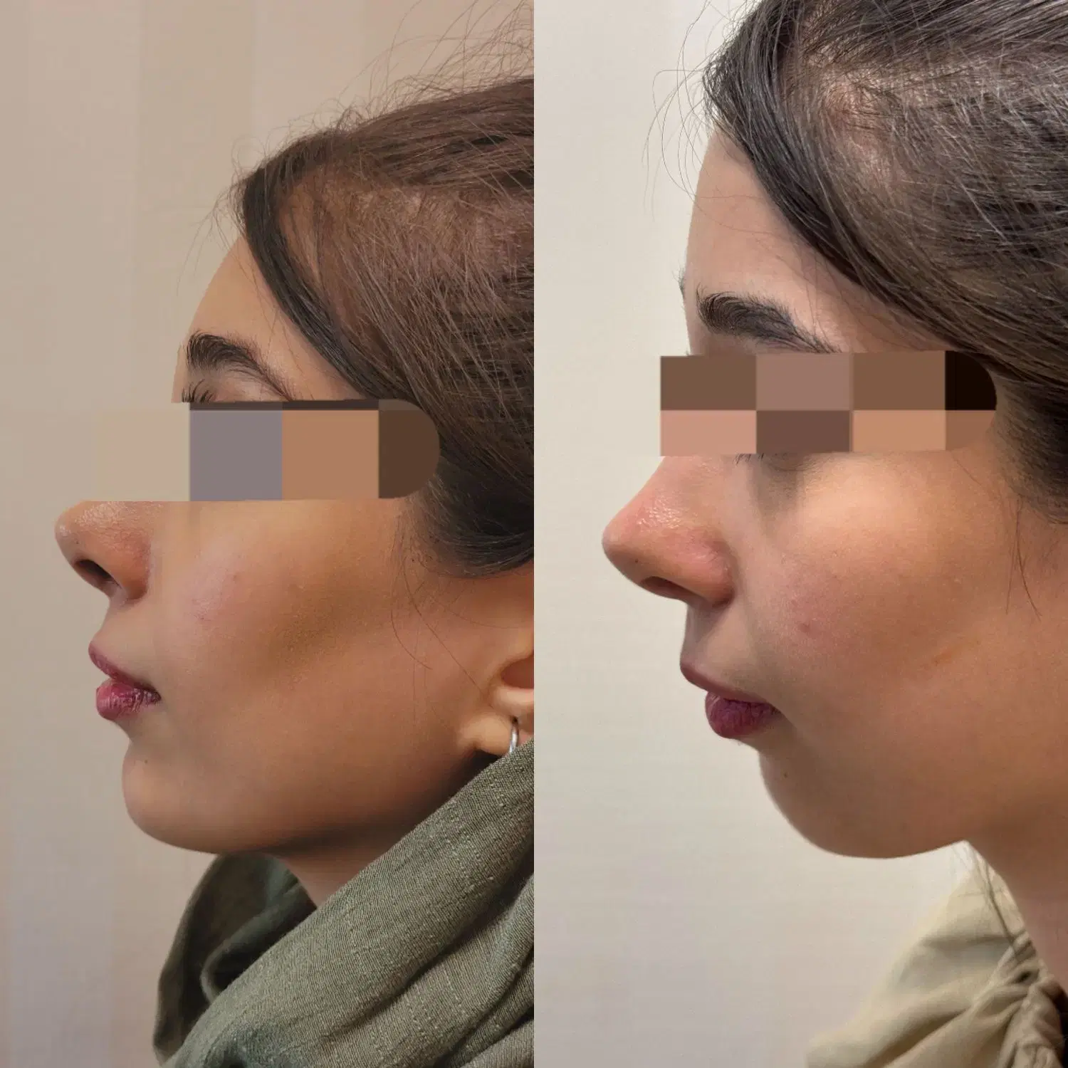 اسپارتینا زیکورپا لاغری بوتاکس فیلر مزوژل نخ لیفت|خدمات زیبایی و سلامت|تهران, هاشمی|دیوار