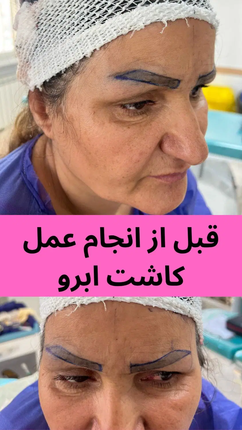 کاشت ابرو جشنواره پاییزه فقط ۶ میلیون|خدمات زیبایی و سلامت|تهران, توحید|دیوار