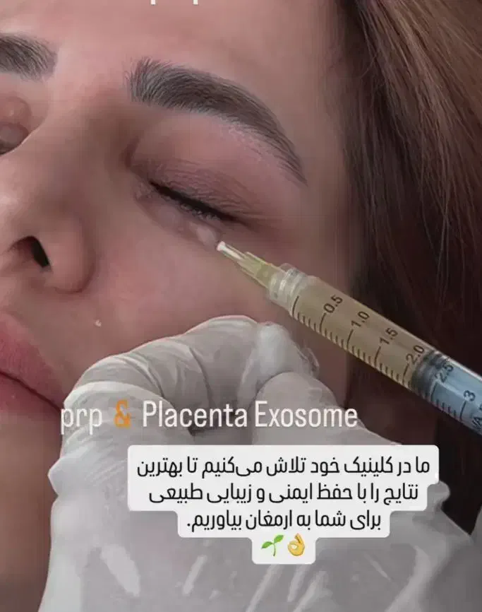 جشنواره پاییزه جوانسازی پوست فیشال پی ارپی اگزوزم|خدمات آرایشگری و زیبایی|مشهد, کوشش|دیوار