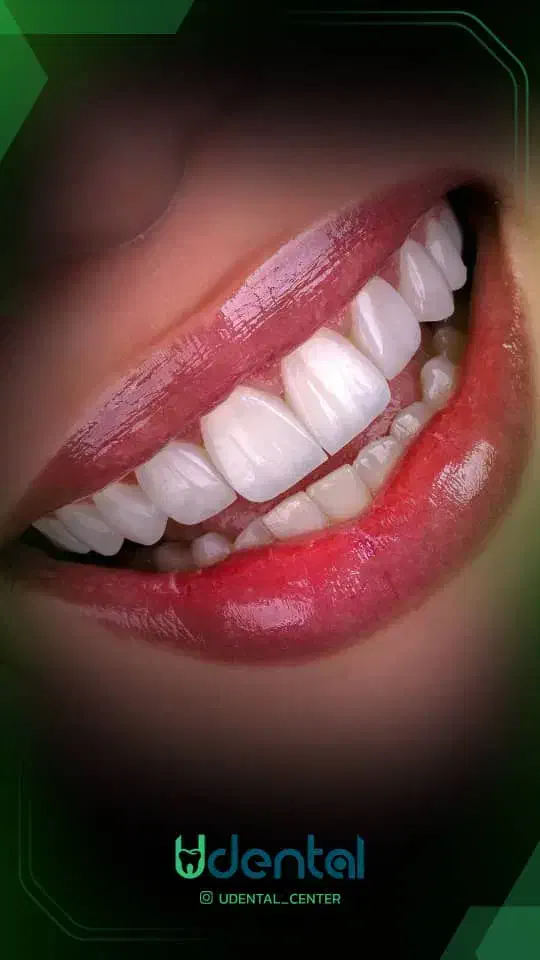 کامپوزیت، لمینت، ایمپلنت اقساط ویژه|خدمات آرایشگری و زیبایی|ایلام, |دیوار