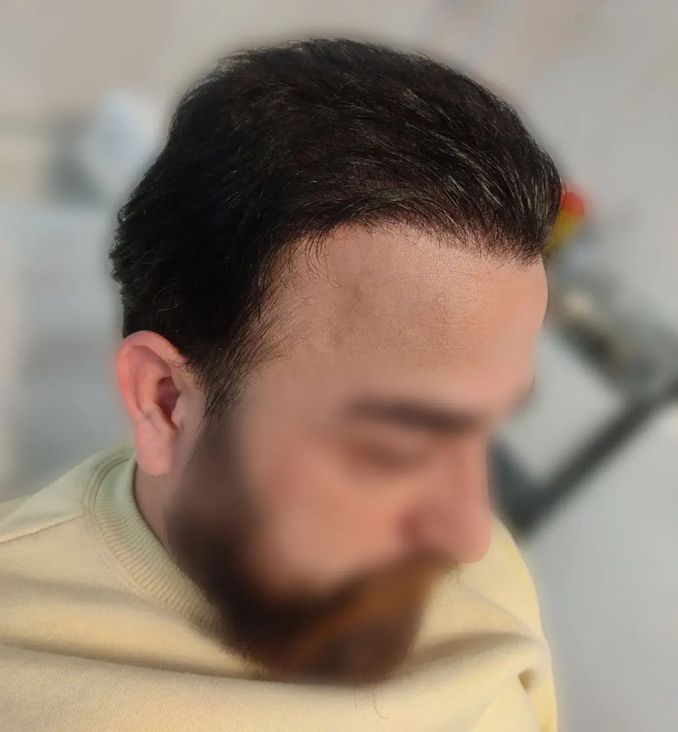 کاشت مو|خدمات آرایشگری و زیبایی|رشت, کاکتوس|دیوار