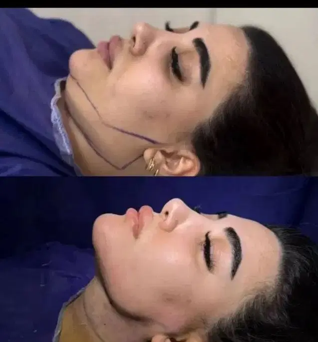 زاویه سازی فک وچربی|خدمات زیبایی و سلامت|اهواز, کیانپارس |دیوار