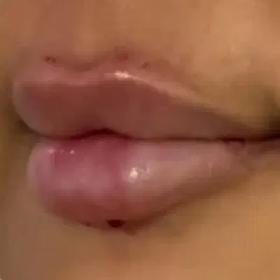 مدل ژل لب گونه چونه بوتاکس|خدمات آرایشگری و زیبایی|اسلام‌شهر, مطهری|دیوار