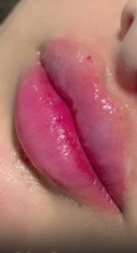 ژل،بوتاکس،مزوتراپی،مزونیدلینگ|خدمات آرایشگری و زیبایی|دوگنبدان, |دیوار