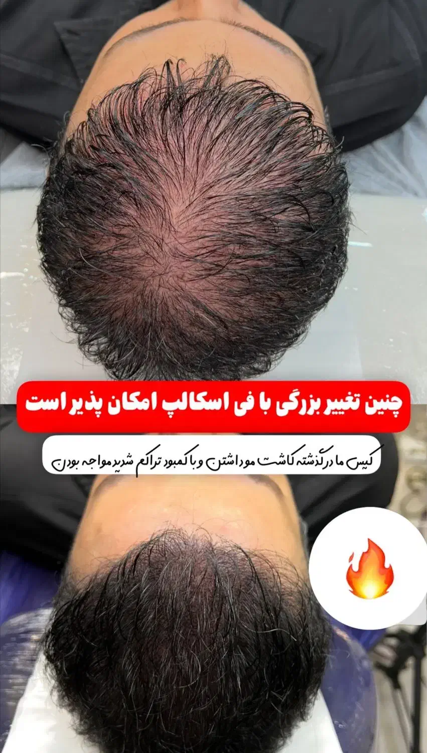 میکرواسکالپ فی اسکالپ سر|خدمات آرایشگری و زیبایی|شیراز, ملاصدرا|دیوار