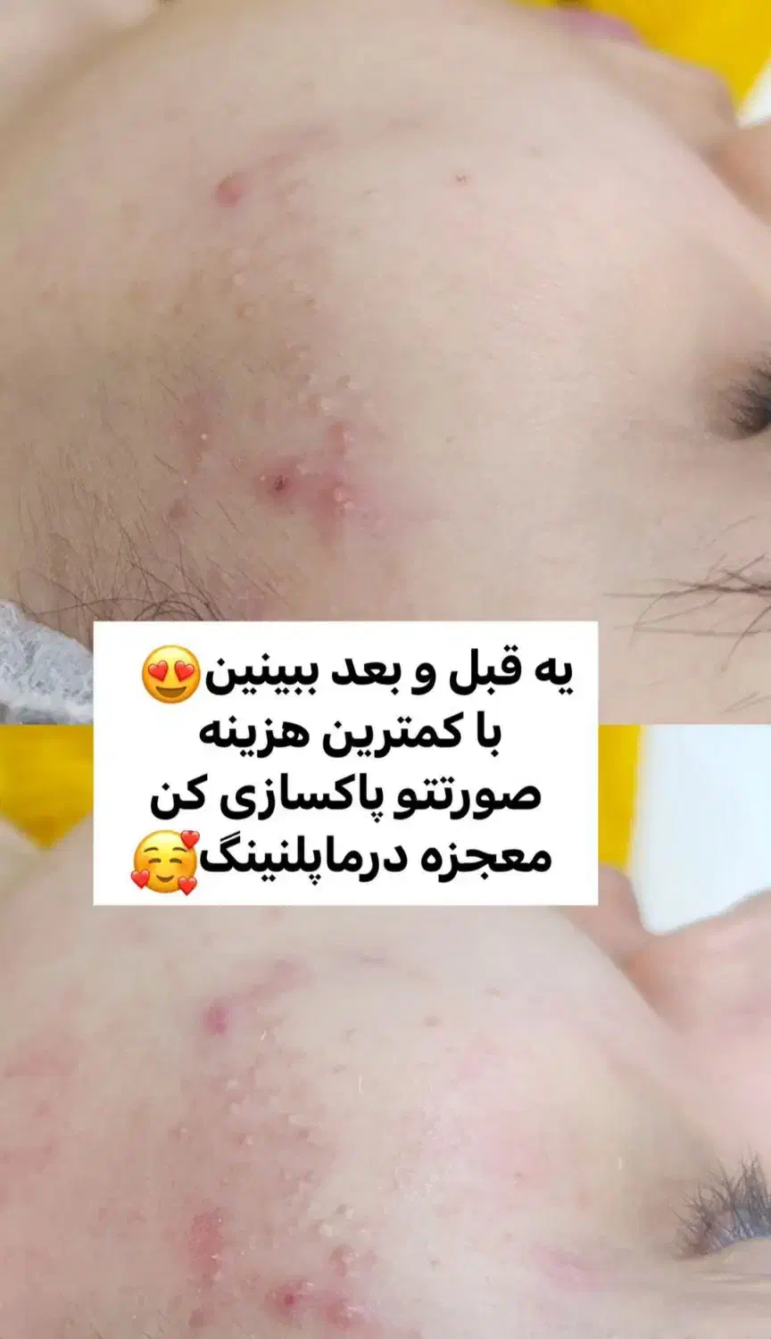 درماپلنینگ تخصصی صورت|خدمات آرایشگری و زیبایی|زابل, |دیوار