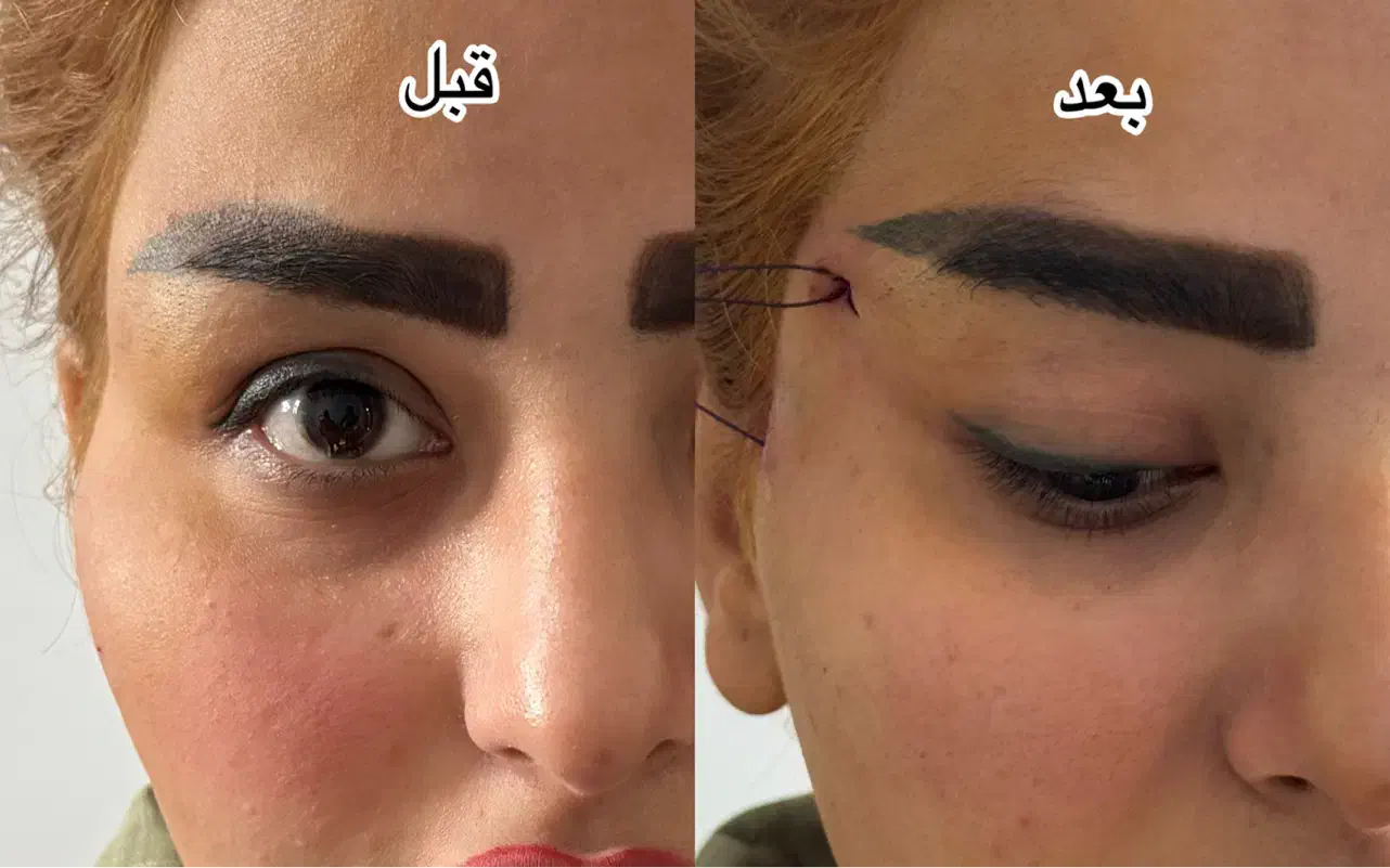 تزریق ژل و بوتاکس-چربی|خدمات آرایشگری و زیبایی|اهواز, کیانپارس |دیوار