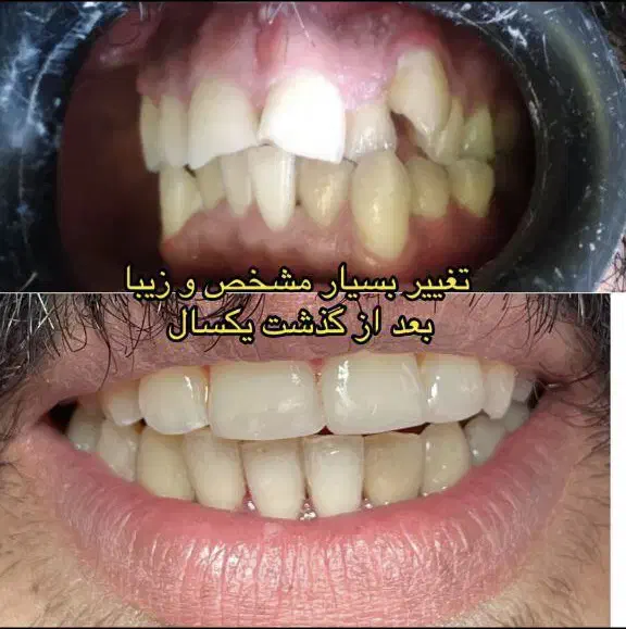 ارتودنسی کامپوزیت لمینت دندان‌مصنوعی ایمپلنت|خدمات آرایشگری و زیبایی|تهران, سلسبیل شمالی|دیوار