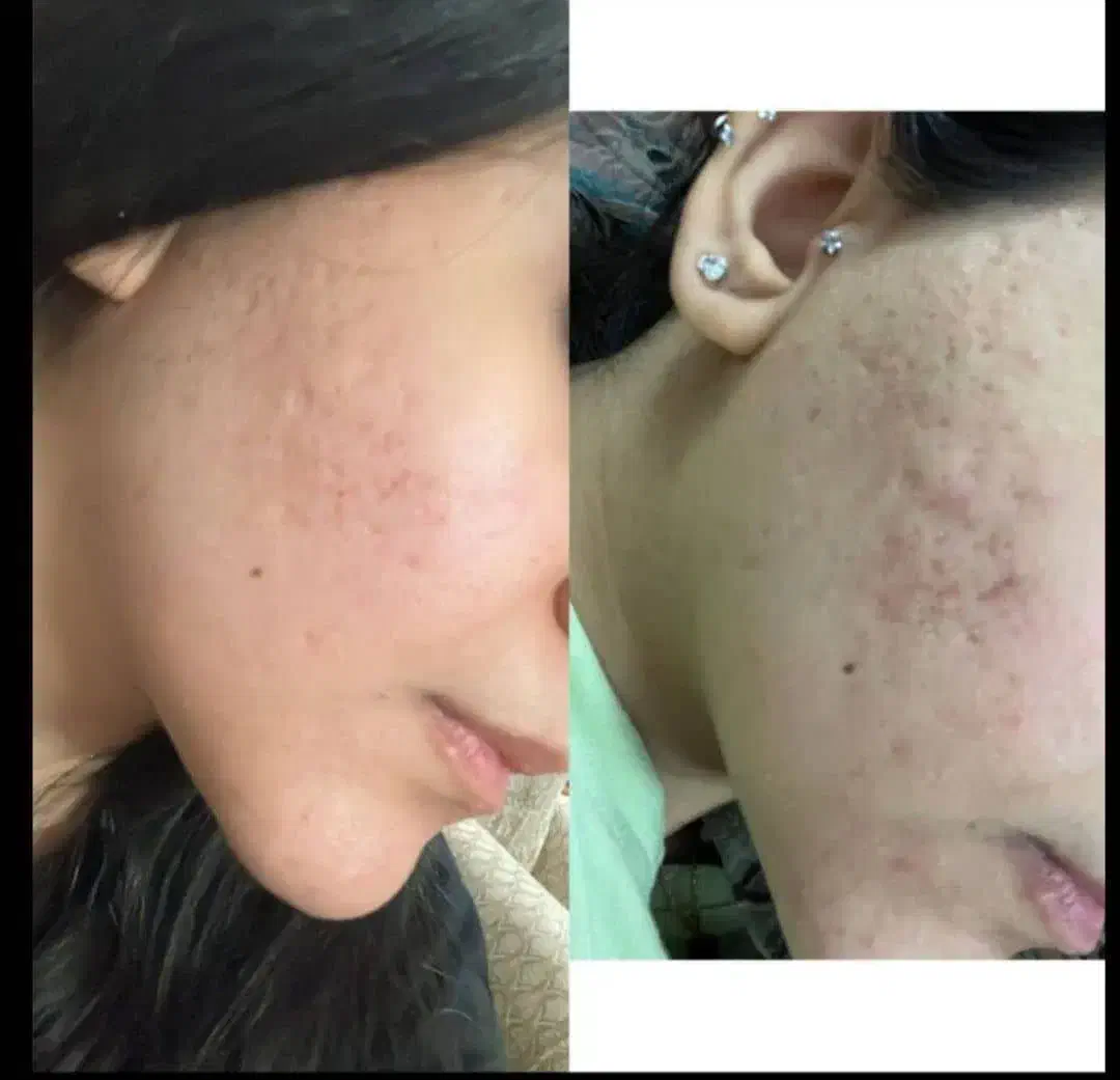 پاکسازی تخصصی پوست با دستگاه|خدمات آرایشگری و زیبایی|لاهیجان, امیرشهید|دیوار