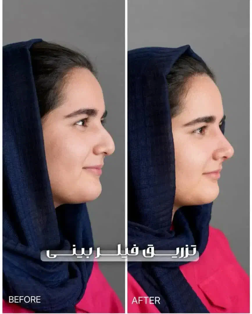 لیفت جراحی بینی بلفارو ژل لب بوتاکس مزو فشیال|خدمات آرایشگری و زیبایی|شاهین‌شهر, طالقانی|دیوار