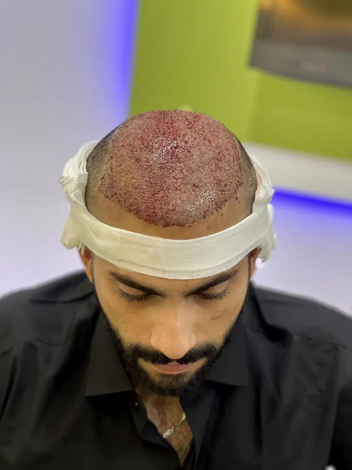 جشنواره  تخفیفی کاشت مو ابرو و مژه|خدمات آرایشگری و زیبایی|قم, سالاریه|دیوار