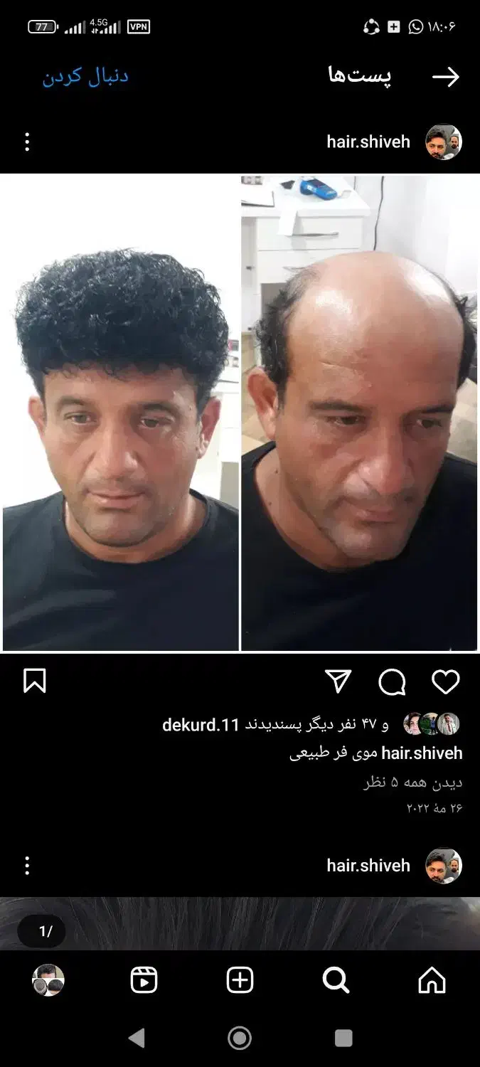 پروتز مو بافت مو ترمیم مو سجادی ارزانتر از همه جا|خدمات آرایشگری و زیبایی|تهران, جوادیه تهرانپارس|دیوار