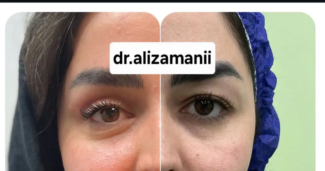 بلفاروپلاستی کاشت ابرو کاشت مو تخفیف|خدمات آرایشگری و زیبایی|تهران, دریاچه شهدای خلیج فارس|دیوار