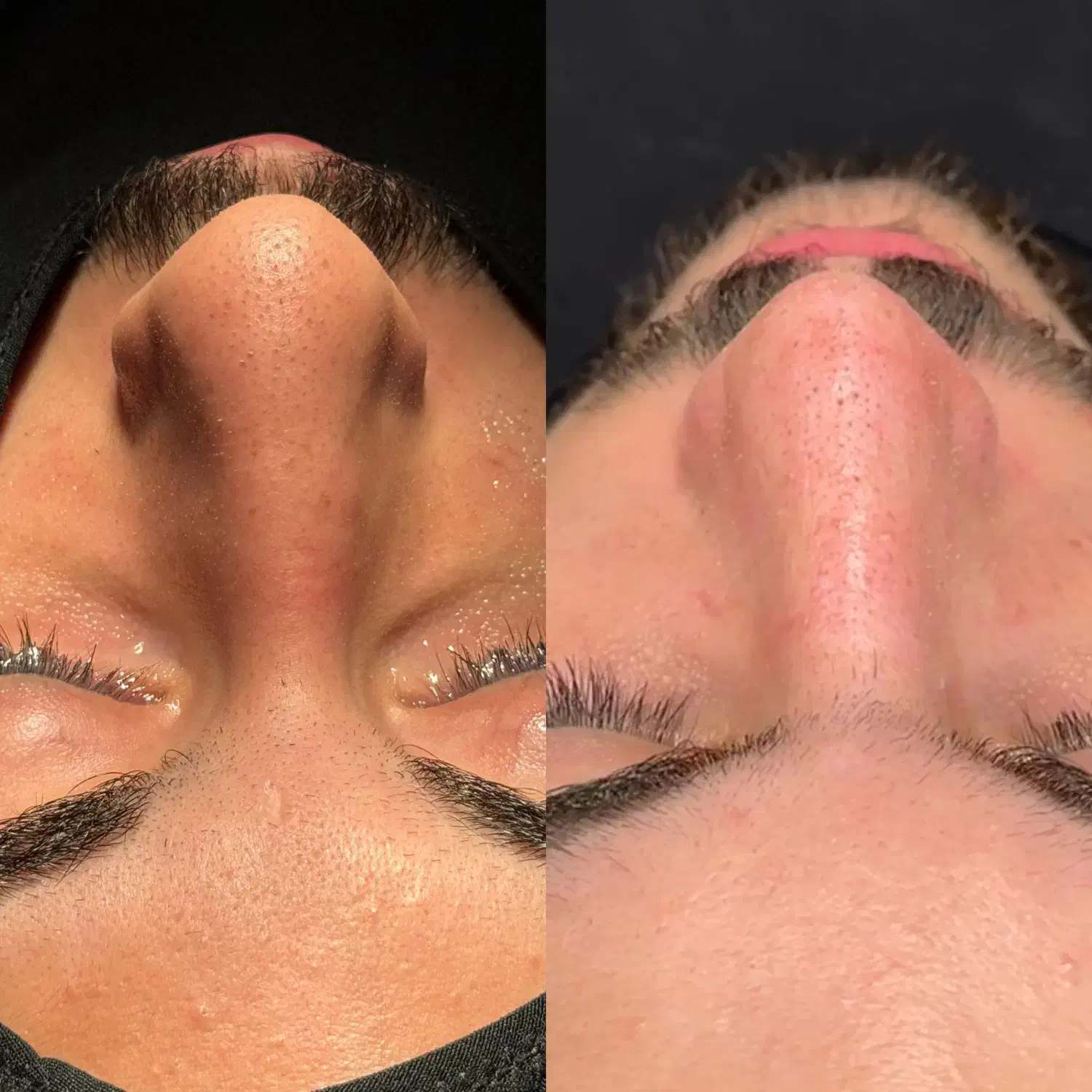 جراحی بینی بدون تامپون|خدمات آرایشگری و زیبایی|تهران, باشگاه نفت|دیوار